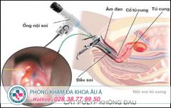 Chi phí cắt polyp cổ tử cung hết bao nhiêu tiền?