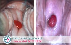 Polyp cổ tử cung là gì?
