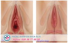 Thẩm mỹ âm đạo giá bao nhiêu?