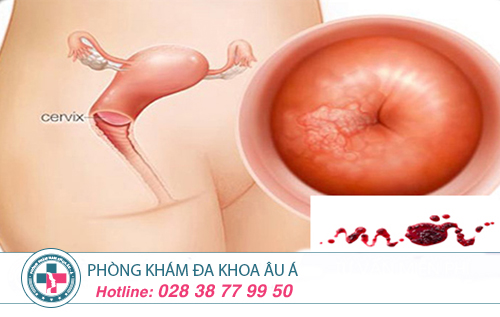 4 Biểu hiện viêm lộ tuyến cổ tử cung ở nữ giới