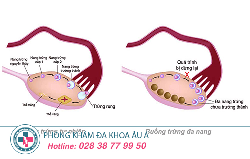Bệnh buồng trứng đa nang và mức độ nguy hại