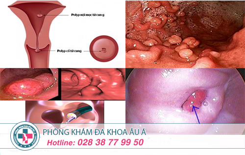 Bệnh polyp cổ tử cung điều trị ở đâu tại TP.HCM