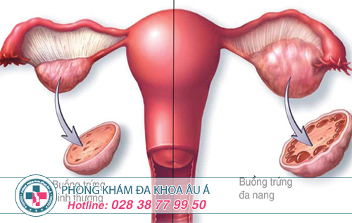 Biểu hiện của bệnh buồng trứng đa nang