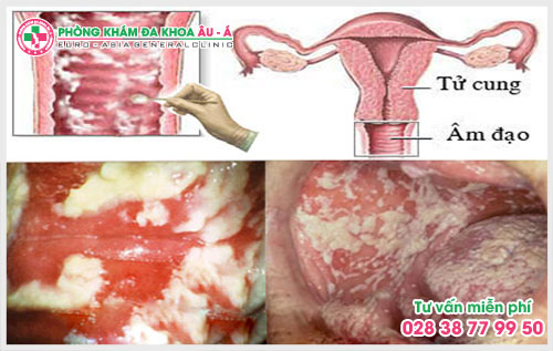 Biểu hiện của viêm âm đạo và cách phòng tránh tốt 