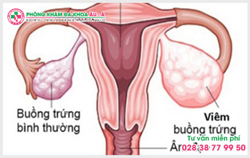 Biểu hiện và triệu chứng của viêm buồng trứng