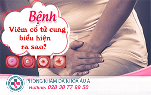 Biểu hiện viêm cổ tử cung mà chị em cần chú ý