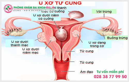 Các dấu hiệu và triệu chứng nhận biết bệnh u xơ tử cung