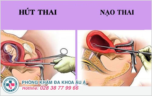 các phương pháp bỏ thai