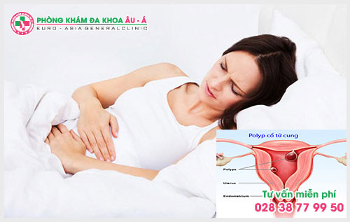 Cách chữa và điều trị polyp cổ tử cung tốt  hiện nay