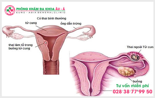 Chi phí điều trị viêm buồng trứng