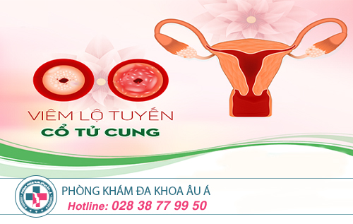 Chi phí điều trị viêm lộ tuyến cổ tử cung hết bao nhiêu?