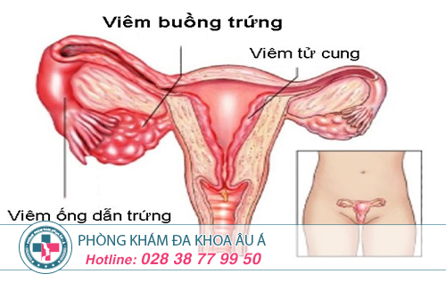 Chi phí điều trị viêm ống dẫn trứng hết bao nhiêu?