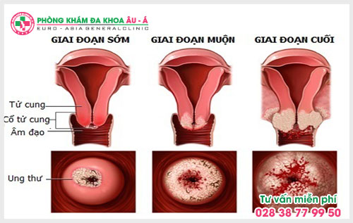 Điều trị viêm cổ tử cung như thế nào?