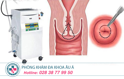 Địa chỉ điều trị viêm cổ tử cung chi phí rẻ