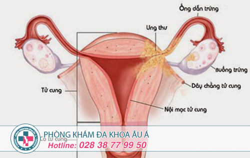 Địa chỉ điều trị viêm ống dẫn trứng hiệu quả