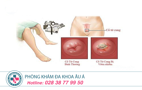 Địa chỉ khám viêm cổ tử cung ở TP.HCM