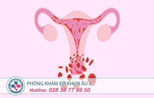 Điểm mặt các triệu chứng polyp cổ tử cung ở nữ giới