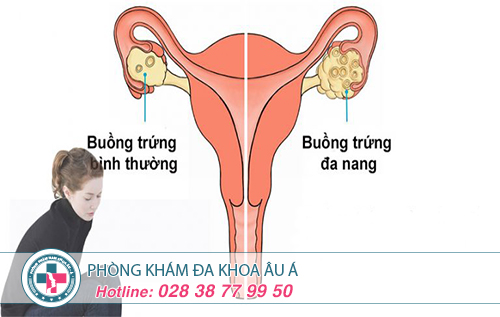 Điều trị đa nang buồng trứng ở đâu hiệu quả tại TPHCM?
