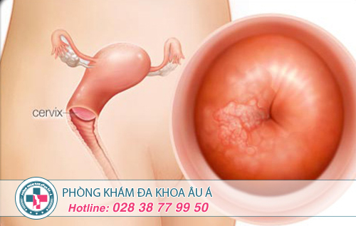 Điều trị viêm cổ tử cung  bằng phương pháp nào?