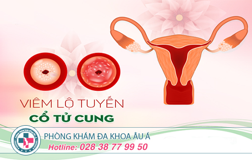 Điều trị viêm lộ tuyến cổ tử cung