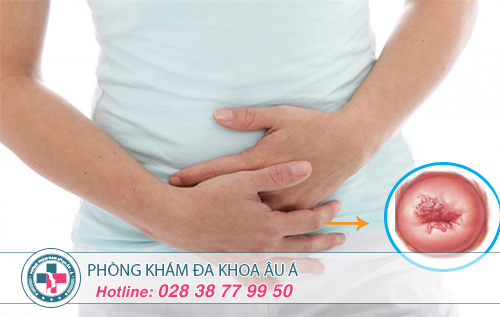 Điều trị viêm lộ tuyến cổ tử cung bằng phương pháp nào hiệu quả