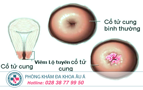 Điều trị viêm lộ tuyến cổ tử cung như thế nào?