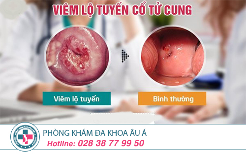 Đốt viêm lộ tuyến cổ tử cung bằng laser có hiệu quả như mong muốn?