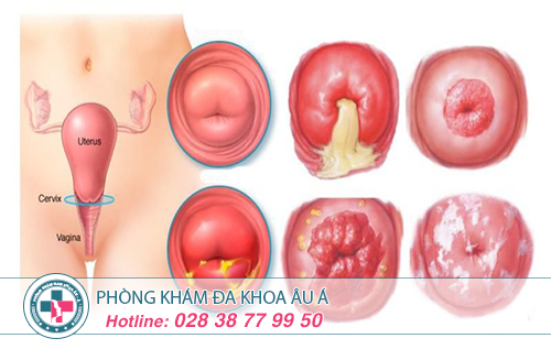Hình ảnh các giai đoạn bệnh viêm lộ tuyến cổ tử cung