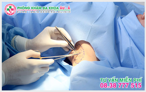 Những lưu ý sau khi phẫu thuật hôi nách