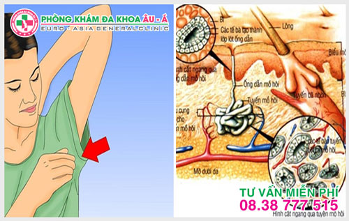 Nguyên nhân nào dẫn đến bệnh hôi nách?