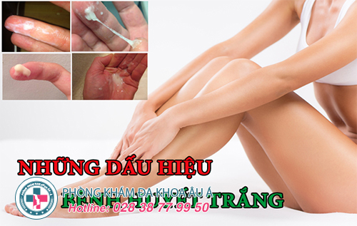 Huyết Trắng Ra Nhiều Có Sao Không?