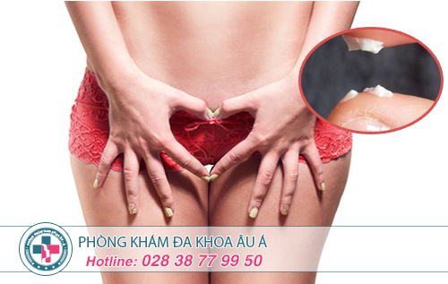 Huyết trắng đặc là bệnh gì?