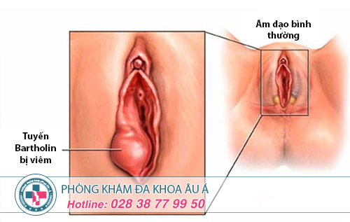 Sưng âm đạo là triệu chứng bệnh gì?