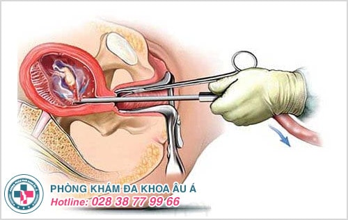 Hút thai an toàn và những điều chị em cần biết