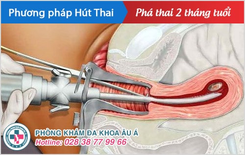 Phá thai 1 tháng, phá thai 2 tháng bằng phương pháp nào an toàn?