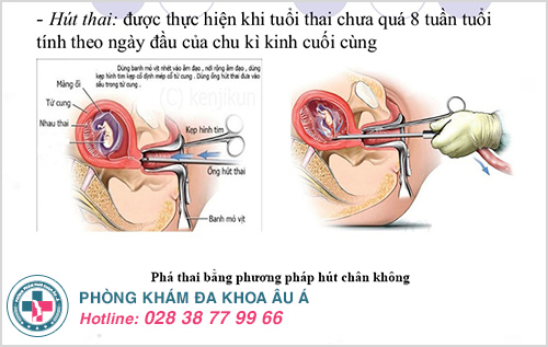 Phương pháp hút thai