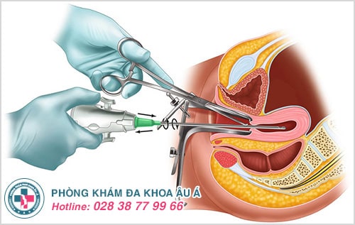 Lành ít dữ nhiều khi nạo hút thai ở phòng khám chui