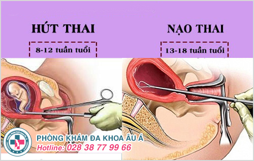 1 số phương pháp nạo thai an toàn Âu Á áp dụng