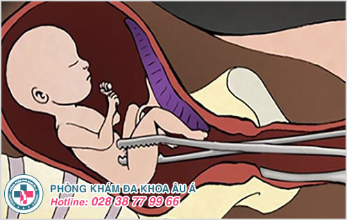 Nong gắp thai có đau không?