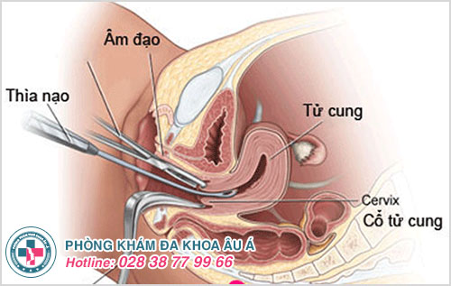 Phá thai 14 tuần có nguy hiểm không?