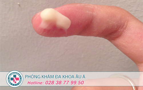 Khí hư có màu trắng đục như bã đậu là bệnh gì?
