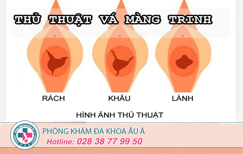 Kỹ thuật vá màng trinh tối ưu  hiện nay