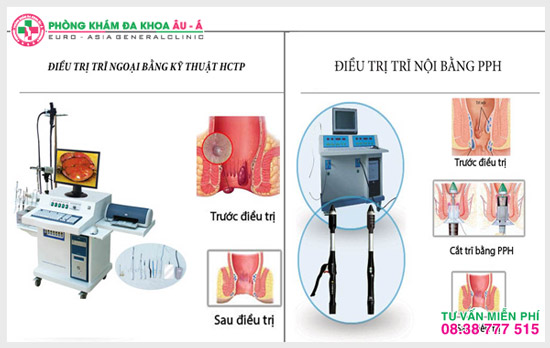 Cách hỗ trợ điều trị trĩ nội, hỗ trợ điều trị trĩ ngoại hiệu quả