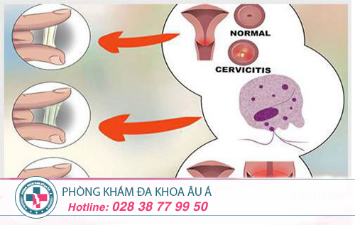 Làm thế nào chữa trị viêm lộ tuyến cổ tử cung?