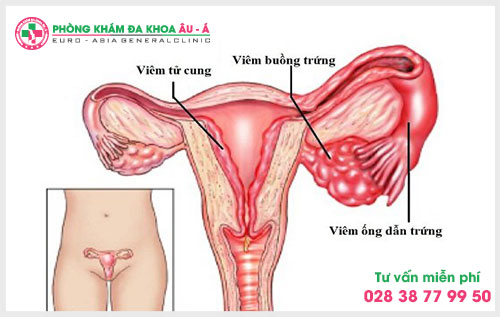 Nguyên nhân gây bệnh viêm buồng trứng là gì?