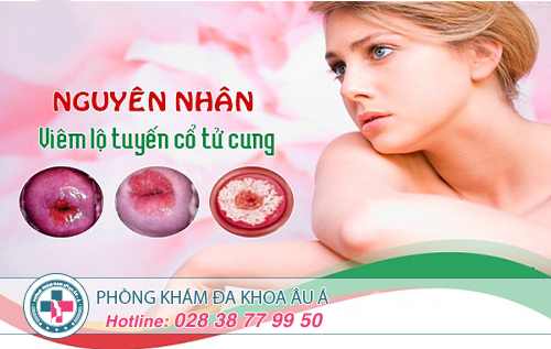 Nguyên nhân gây bệnh viêm lộ tuyến cổ tử cung