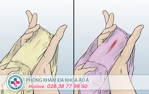 Nguyên nhân huyết trắng ra nhiều