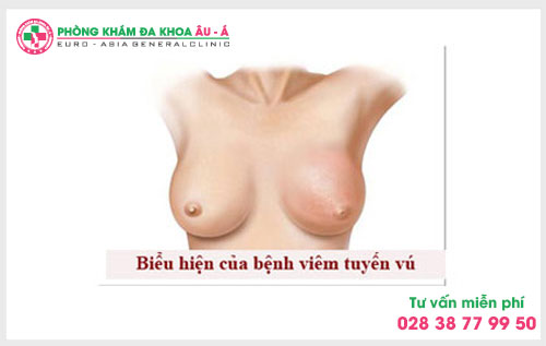Nguyên nhân và tác hại của bệnh viêm tuyến vú