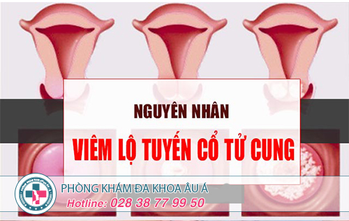 Nguyên nhân viêm lộ tuyến cổ tử cung là gì?