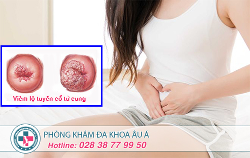 Những dấu hiệu viêm lộ tuyến cổ tử cung mà nữ giới nên biết